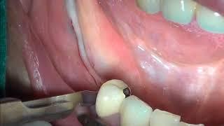Apical repostioned flap