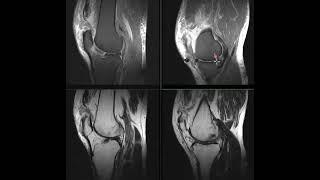 BILATERAL ACL AND QUADRACEPS TENDON TEARS FROM FALL