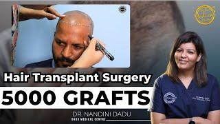 5000 Grafts Hair Transplant Transformation | Hair Transplant Clinic  | Dadu Medical Centre