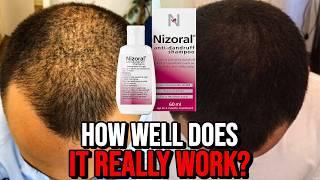 Ketoconazole Shampoo for Hair Growth - How Well Does it REALLY Work?