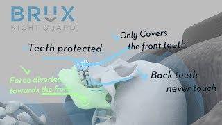 Why Choose Brux Night Guard for Teeth Grinding and Clenching?