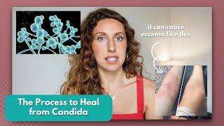 The Easiest Process to Heal Candida Overgrowth Naturally