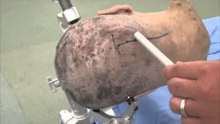 Skull Clamp Placement: Suboccipital Craniotomy-Incision (Preview)