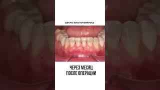 лечение рецессии десны позволяет вернуть молодой вид и продлить срок службы зубов на десятки лет