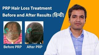 PRP hair loss treatment before and after results in Hindi | Side effects of prp hair loss treatment