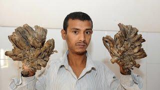 Surgeries Give “Tree Man” His Life Back