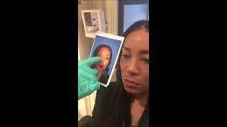 Ethnic Rhinoplasty Follow-Up | Dr. Rizk, Top NYC Plastic Surgeon