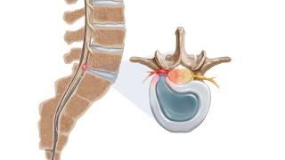 IntelliSpine Lumbar Laser Procedure