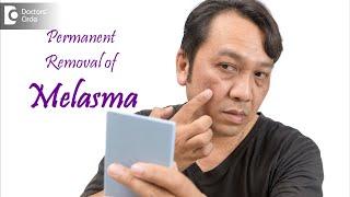 Can melasma be removed permanently? - Dr. Sahebgowda Shetty | Doctors' Circle