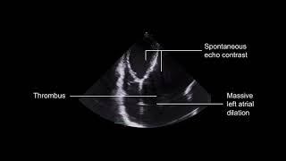 Grading mitral stenosis