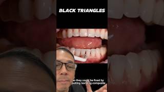 Filling Black Triangles with Resin Composite | In Office to Hands On Dental Training #shorts