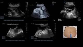 PoCUS in Late Pregnancy   OBcast