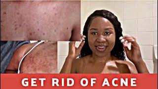 Skin care routine for ACNE prone skin|Affordable products|WOC friendly