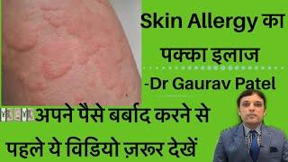 स्किन ऐलर्जी का इलाज।Skin Allergy Treatment At Home| By Dermatologist Dr Gaurav Patel #skinallergy