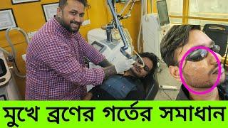ব্রণের দাগ ও গর্তের চিকিৎসা | Laser treatment for acne scars in Bangla |  ব্রণের দাগের চিকিৎসা