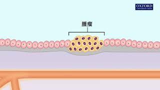 動畫22.1 癌的發展過程