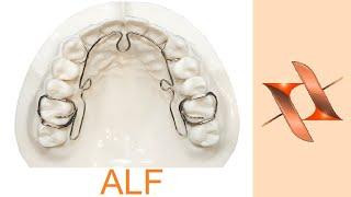 Аппарат "лёгких сил" ALF. Ортодонтия.