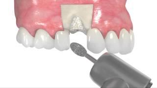 maxgraft® bonering animation