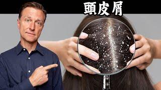 消除頭皮屑,原因與益生菌自然療法,柏格醫生 Dr Berg