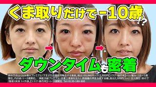 メイクで隠せない クマ をなんとかしたい！34歳女性の クマ取り に密着【 目の下のふくらみ取り 】