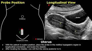 Uterus & Ovaries Ultrasound Probe Positioning | Transducer Placement | Gynecological USG Scanning