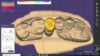 Exocad : Design perfect crown in 5 minutes