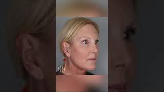 Check Out This Beautiful, Natural Facelift Before And After!