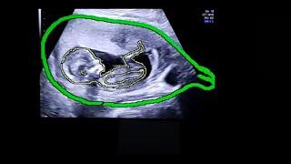 Ultrasound Revelation: Finding out the sex of the baby live - Pregnancy 13 weeks 1 day