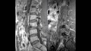 Lumbar spine pain for over 10 years