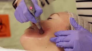 Microneedling Demo