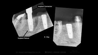 Computer Guided Implant Surgery | 3D simulation | Anand | Gujarat