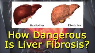 How Dangerous Is Liver Fibrosis?