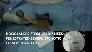 Endoscopic Spine Surgery | Hybrid Procedure for Back Pain and Sciatica