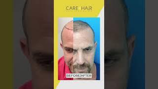 Antes y Después - Transplante de cabello #fuehair | Care4Hair