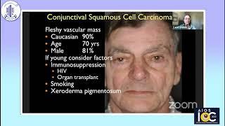 Conjunctival Squamous Neoplasia Impact of Cigarettes and Vaping, and Where is the Interferon?