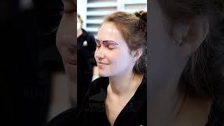 FEMALE EYEBROW TRANSPLANT - 400 GRAFTS