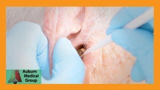 Chuck's Tough Ear Wax Removal Part 1 | Auburn Medical Group