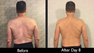 Unwinding Scoliosis Naturally with Block Therapy & Fluid Isometrics