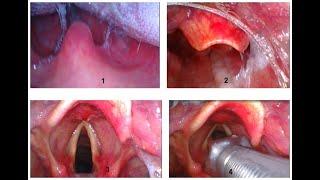 clinical video for BD-DF video laryngoscope