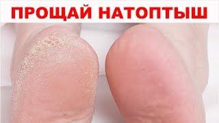 Натоптыши, сухие мозоли, трещины на пятках не дают покоя? 5 СУПЕР СПОСОБОВ гарантированно помогут