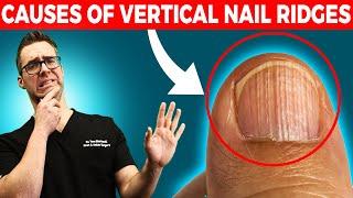 Do you have Vertical Nail Ridges?  [Causes & Treatment]