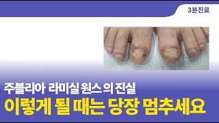 Athlete's foot treatment drug side effects (Athlete's foot series 3) : 3 minutes treatment