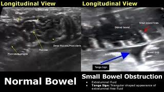 Abdominal Ultrasound Normal Vs Abnormal Images | Liver, Gallbladder, Pancreas, Kidney, Hernia USG