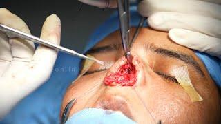 A Day In The Life of Plastic Surgery With Dr. Sunil Richardson - Nose Job Surgery - Before After