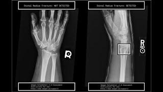 Detecting Bone Fracture with AI| +91-7973788405 for query| Webtunix_AI