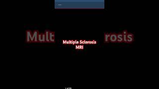 MS MRI: Seeing The Invisible