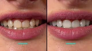 Teeth Whitening: Perfekte Zähne mit Bleaching Germany – SHR Germany
