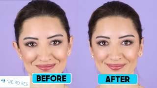 How to fix protruding ears without surgery