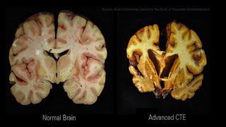 Concussion research at UBC: sports and head trauma