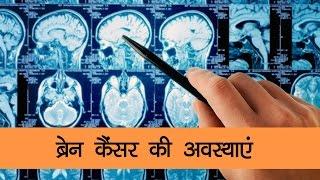 ब्रेन कैंसर की अवस्थाएं - Onlymyhealth.com